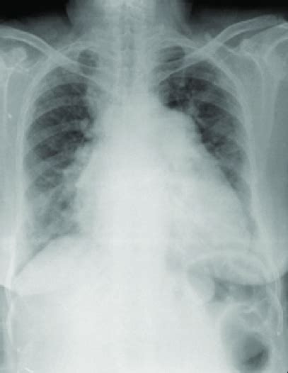 Chest X Ray Postero Anterior View Showing Cardiomegaly And Bilateral