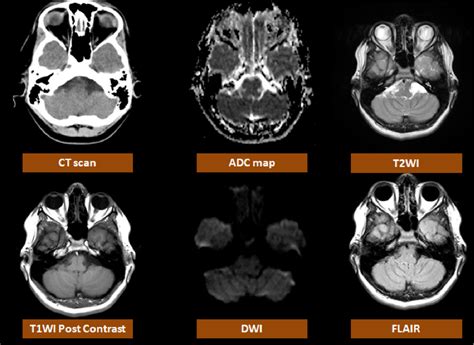 Posterior Cranial Fossa Tumor | Hot Sex Picture