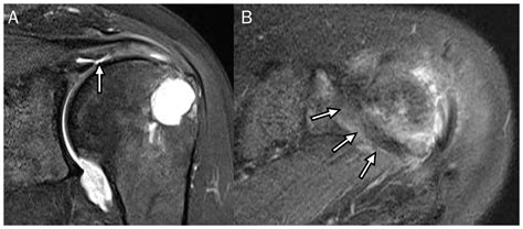 Diagnostics Free Full Text Delaminated Tears Of The Rotator Cuff Mri Interpretation With