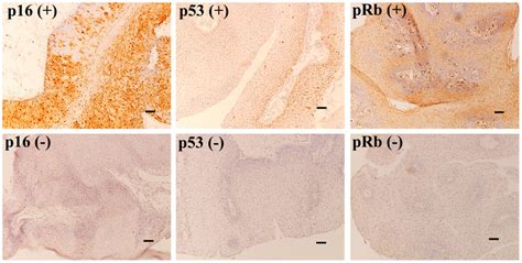 Immunohistochemistry For P16 P53 And Prb In Ao Lp Positive Download Scientific Diagram