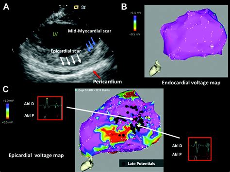 Assessing Epicardial Substrate Using Intracardiac Echocardiography