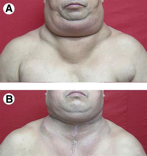 Surgical Treatment Of Multiple Symmetric Lipomatosis Madelungs