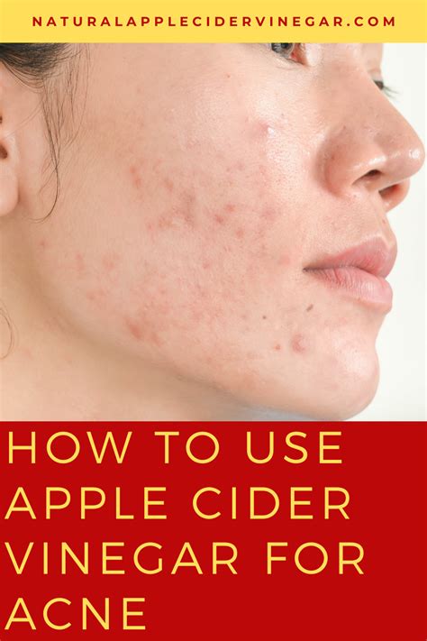 Acv For Acne Artofit