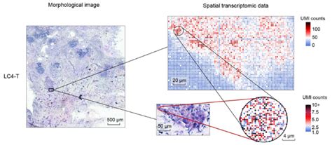 Unveiling Tumor Microenvironment Dynamics Stereo Seq Sheds Light On Liver Cancer Progression