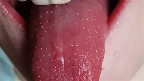 Sore Throat And Bumps On Tongue