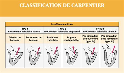 Classification De Carpentier Npem