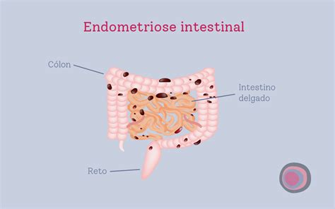 Endometriose Profunda O Que E Quais S O Os Sintomas