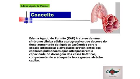 Aula 11 Edema agudo de pulmão pptx