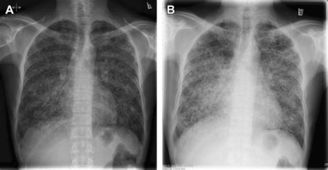 Pneumocystis Pneumonia Associated With Human Immunodeficiency Virus Clinics In Chest Medicine