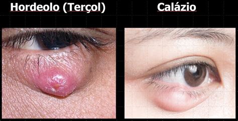 Cal Zio No Olho Causas Sintomas Tratamento Cirurgia