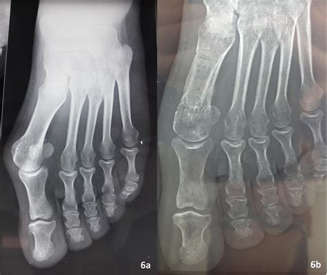 scarf osteotomy | The Foot and Ankle Online Journal