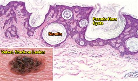 Skin Tumors Flashcards | Quizlet