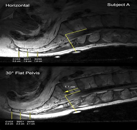 Visualizing Tissue Strain Under The Sacrum And Coccyx In Dif