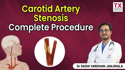 Carotid Artery Stenosis Procedure Explained By DR Shasi Janjirala TX