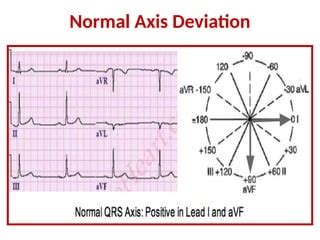 lecture  cardiac axis  ecg  nurses pptx