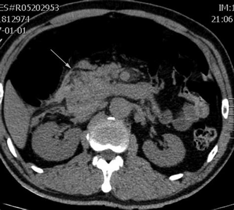 Noncontrast Ct Of The Abdomen Showed Enlargement Of Pancreatic Head And