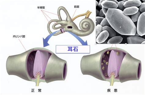 【Dr.ブログ】耳石によるめまい、良性発作性頭位めまい症は、耳の骨そしょう症 | 朴澤耳鼻咽喉科ニュース＆ブログ