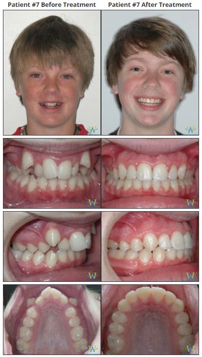 Braces Before & Afters | Walton Orthodontics