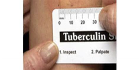 Mantoux Tuberculin Skin Test Toolkit Tuberculosis Tb Cdc