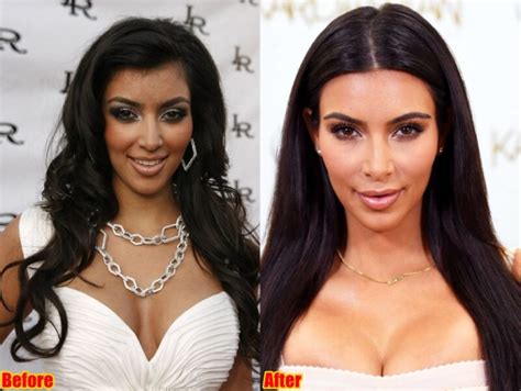 Kim Kardashian Plastic Surgery Journey - Before & After