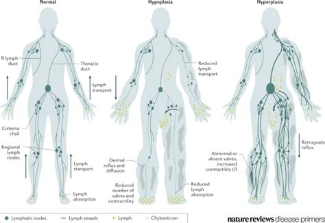 Nature Reviews Disease Primers On Twitter Primary Lymphoedema Can Be