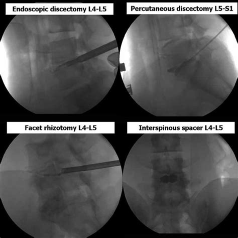 Minimally invasive spine procedures at L4-5 and L5-S1 levels ...