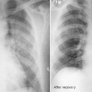 Pulmonary Edema Ultrasound