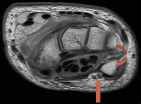 Figure 3 from The Guyon’s canal in perspective: 3-T MRI assessment of the normal anatomy, the ...