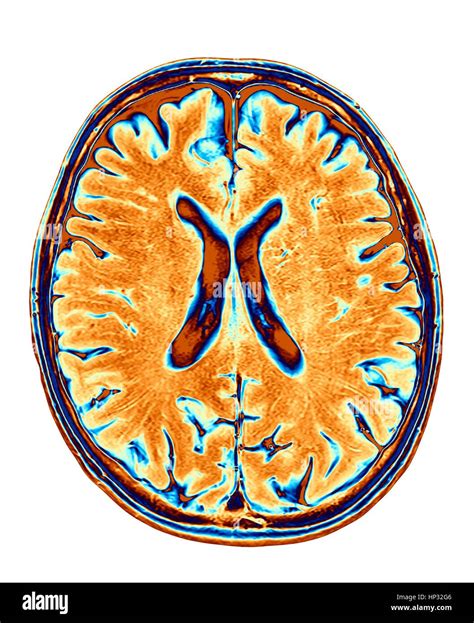 Normal Brain Mri Hi Res Stock Photography And Images Alamy