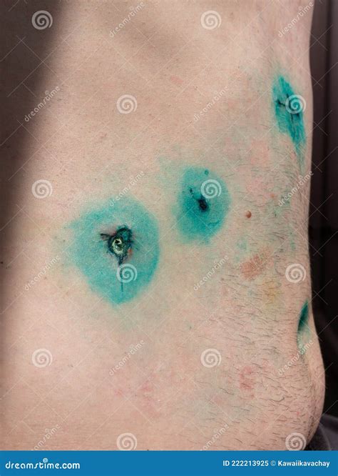 Male Body With Incisions After Gallbladder Laparoscopic Surgery Gallstones Endoscopy Removing