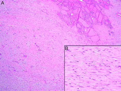 A Bland Spindle Cell Proliferation Arranged In Ill Defined Fascicles