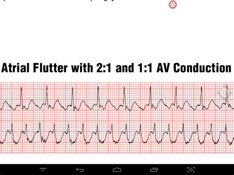 KHMER MEDECINE Atrial Flutter