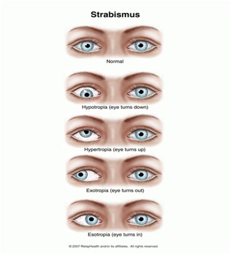 Squint vs Pseudosquint - Eyescreen™