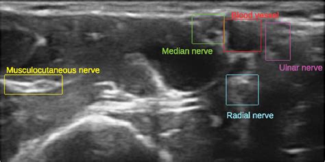 Axillary Block Ultrasound