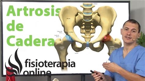 Artrosis O Desgaste De Cadera Qu Es Causas S Ntomas Y Tratamiento