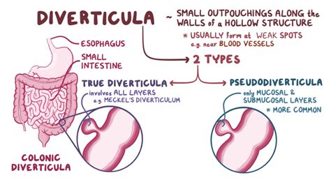 Vasa Recta Diverticulosis