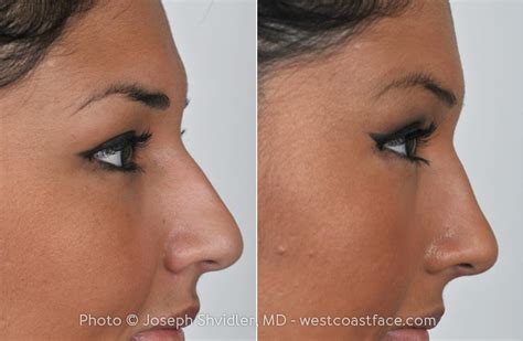 Rhinoplasty Seattle WA Nose Job Surgery Seattle Washington