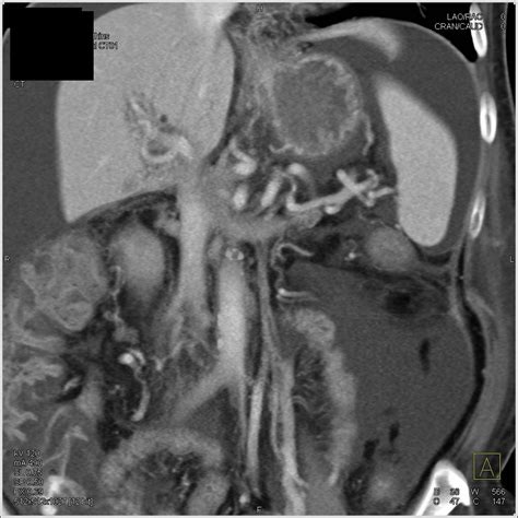 Pancreatic Cancer Encases The Portal Vein And Superior Mesenteric Vein