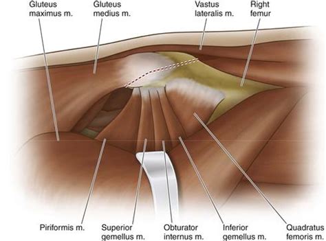 Trochanteric Osteotomy | Musculoskeletal Key