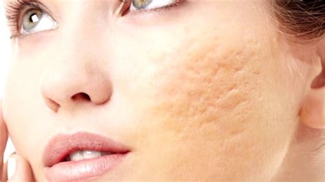 Cicatrizes De Acne Como Eliminar Mybeleza