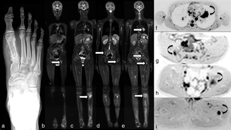 Thirteen Year Old Male With A Biopsy Proven Ewing Sarcoma Of The First