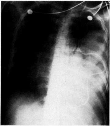 Empyema Due To Ventriculopleural Shunt Chest