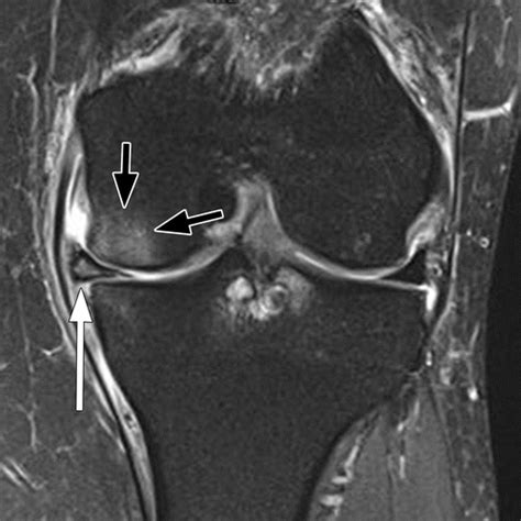 State Of The Art Imaging Of Osteoarthritis—revisited 2020 Radiology