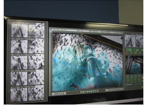 Figure 4 From Follicular Unit Extraction With The Artas Robotic Hair