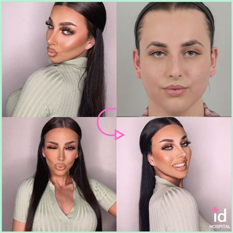 Ffs Transformation At Id Hospital Facial Feminization Surgery Facial