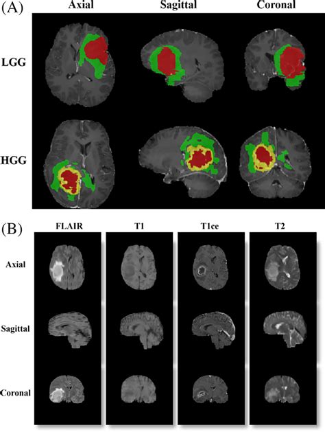 A Grades Of Glioma—low‐grade Glioma And High‐grade Glioma45 B Download Scientific Diagram