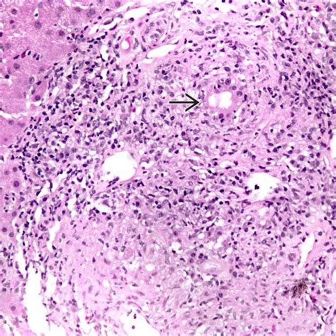 Primary Biliary Cholangitis Basicmedical Key