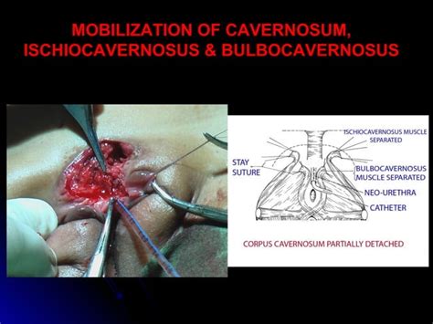 Partial Penile Disassembly For Single Stage Repair Of Male Epispadias