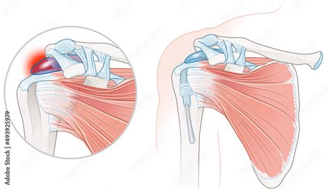 Rotator Cuff Bursitis Shoulder Illustration. Labeled Stock Illustration ...