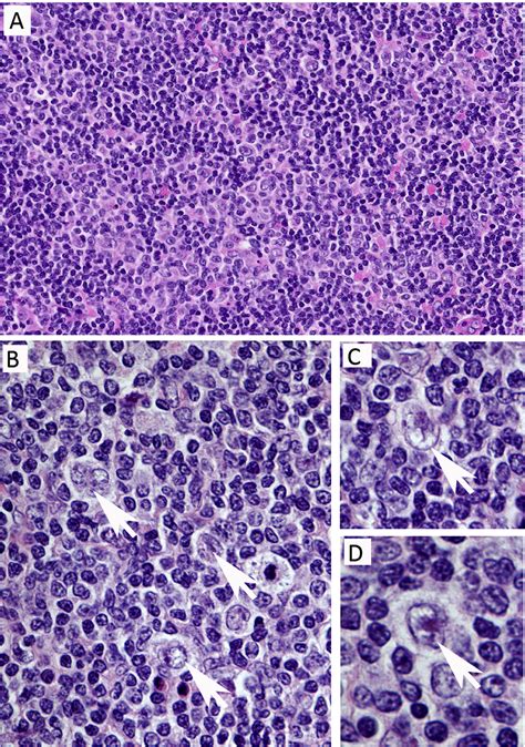 Nodular Lymphocyte Predominant Hodgkin Lymphoma Pathology Clinical